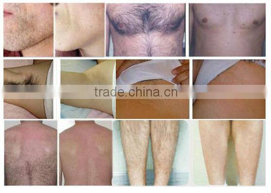 Newest diode 808 laser for hair removal