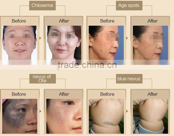 Professional Tattoos removal medical laser machine 532nm/1064nm Q-switched Nd-YAG Laser