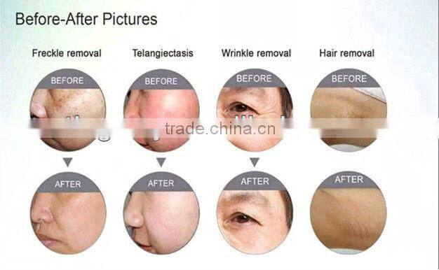 2013 best laser hair removal machine tm-j108