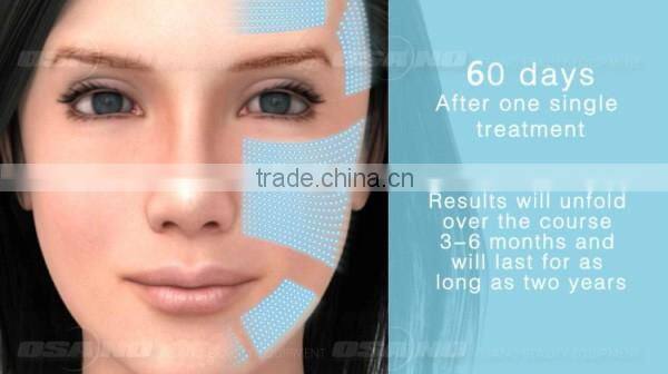 Osano hifu machine / hifu face lift / 3 transducer hifu machine for wrinkle removal