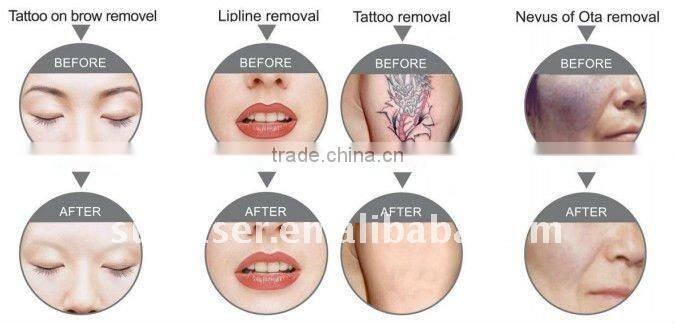 Vertical Q-Switched YAG Laser Tattoo Removal laser vein blood cpillry therpy machine