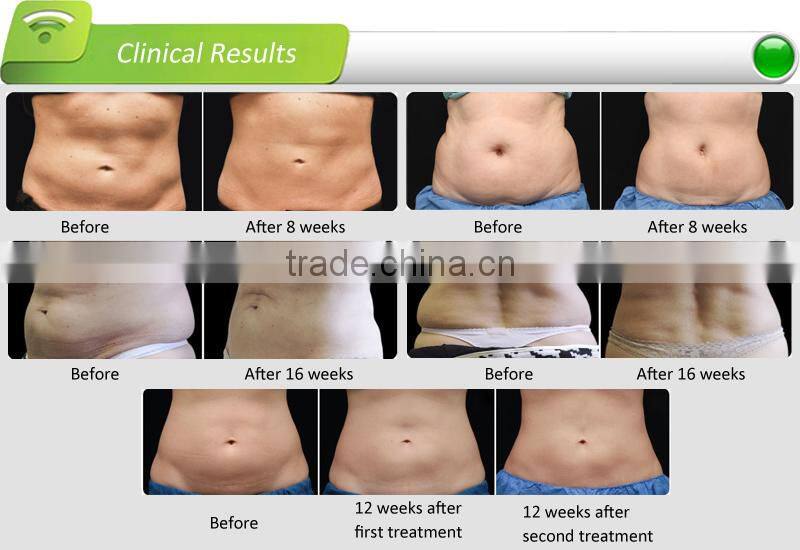 New Product Fat Freezing Machine / Multifunction Cryolipolysis Machine