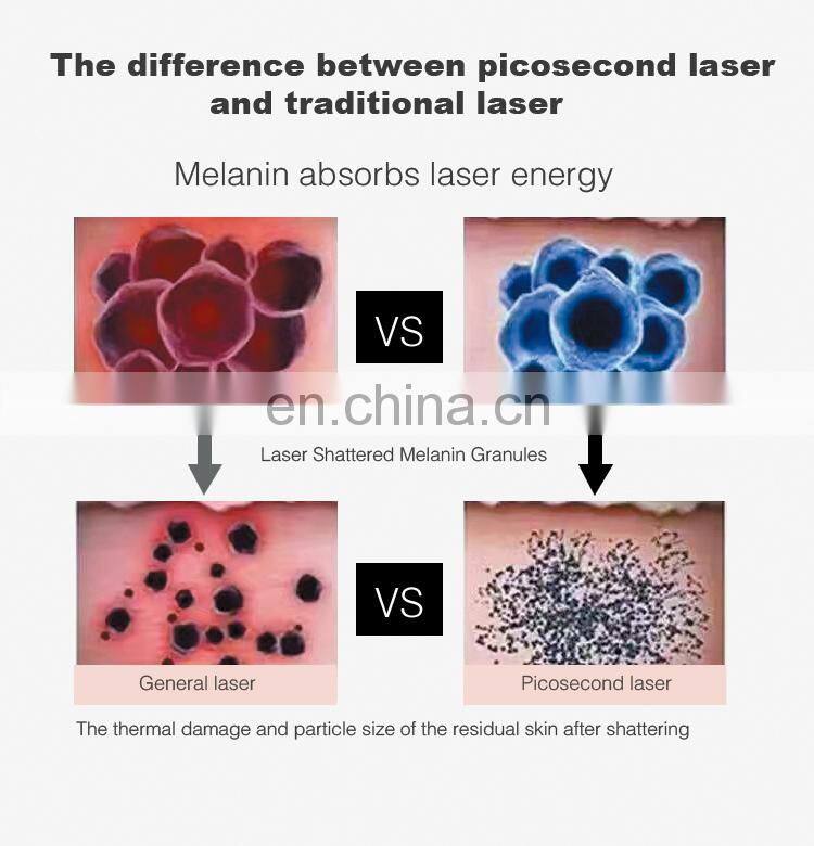 Picosecond tattoo removal laser beauty equipment popular q switched nd yag laser machine for sale