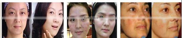 Led mask magic light rejuvenation