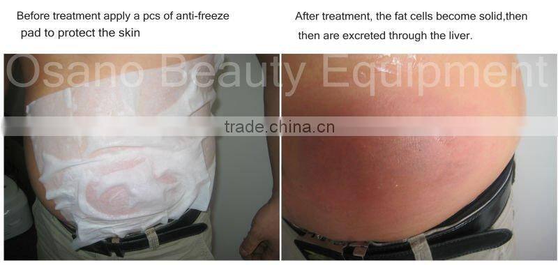 Portable Cool body shaping Cool Body Sculpting Machine for Home use