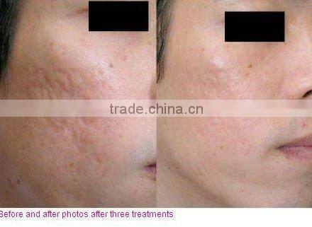 Mini Professional removal hair for leg hair body hair E-light (IPL+RF)