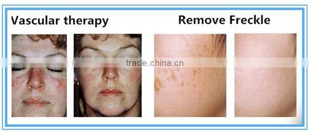 ipl laser hair removel epilation machine lumenis price for sale with ce