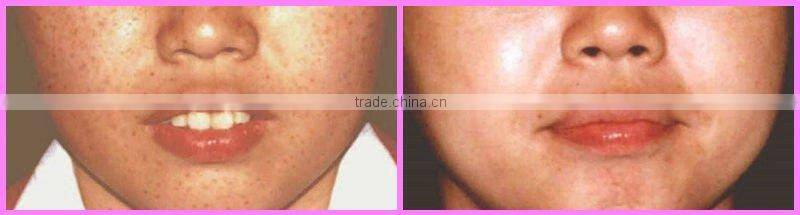 E08 multi-functional ipl machine