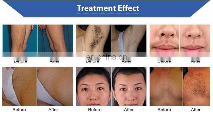 2020 Top-seller Portable 808 Diode Laser Permanent Hair Removal Machine