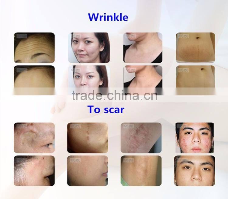 Super Popular Ultra Pulse Fractional Co2 Laser System