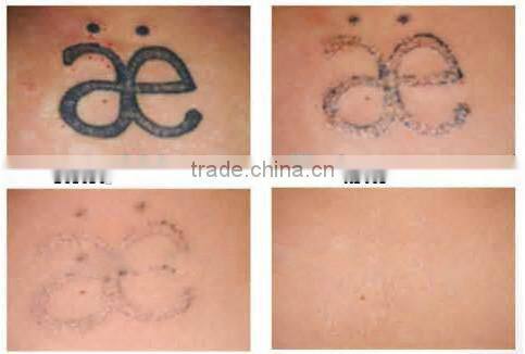 6Hz 532nm / 1064nm Tattoo Removal ND YAG Laser machine