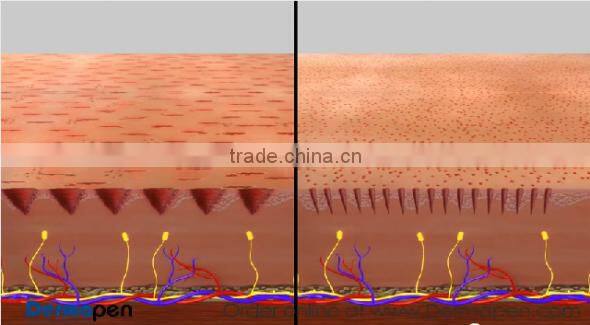 new type cosmetic use electric derma stamp micro needle treatment NL-EDP04