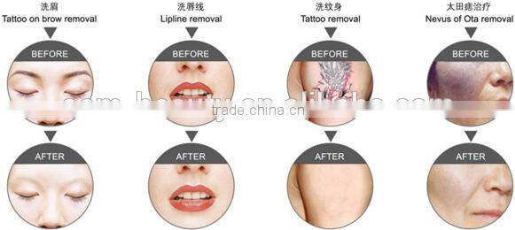 nd yag laser tattoo removal device q switch nd yag laser 1500mj laser tattoo removal
