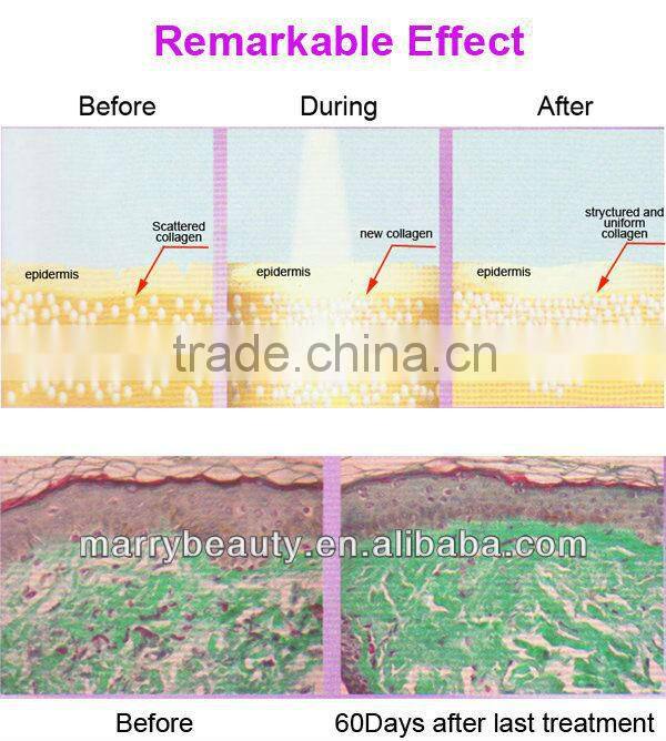 Hot New Products for 2013 IPL Skin Rejuvenation Machine Home