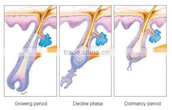 multifunction yag laser hair removal multi-languages large spot size with Russia imported rod