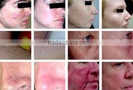IPL Skin-rejuvenation, skin-whitening and enhancement of skin elasticity machine