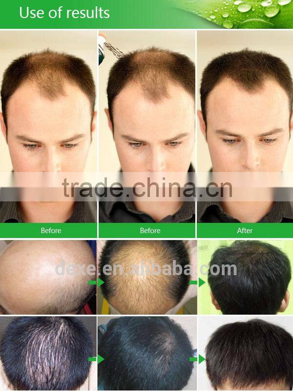 dexe hair building fibers bald head hair growth hair growth spray for man