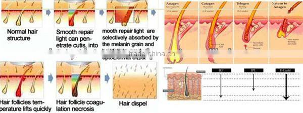 50% off big promotion best price ipl diode laser hair removal machine price