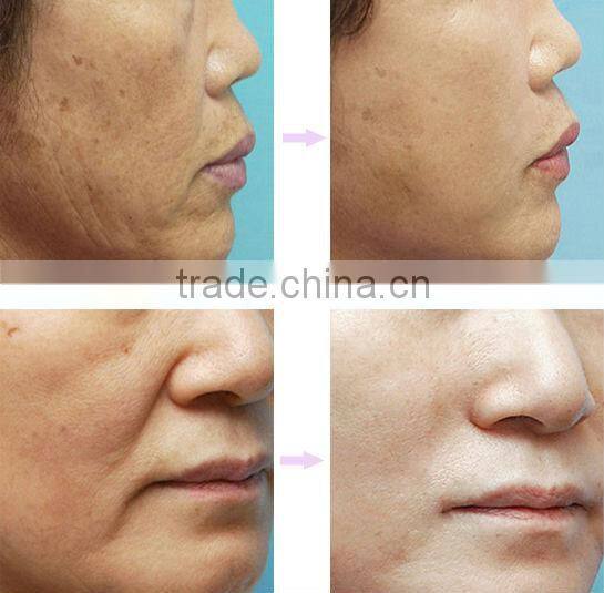 bequty salon use intense pulse light IPL for hair removal machine A003 beauty salon pigment removal skin rejuvenation machine