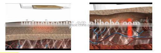 Fractional RF Slimming machine