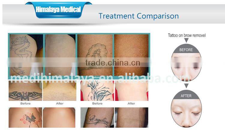 With medical CE 1064nm 532nm Q switch nd yag laser for tattoo removal