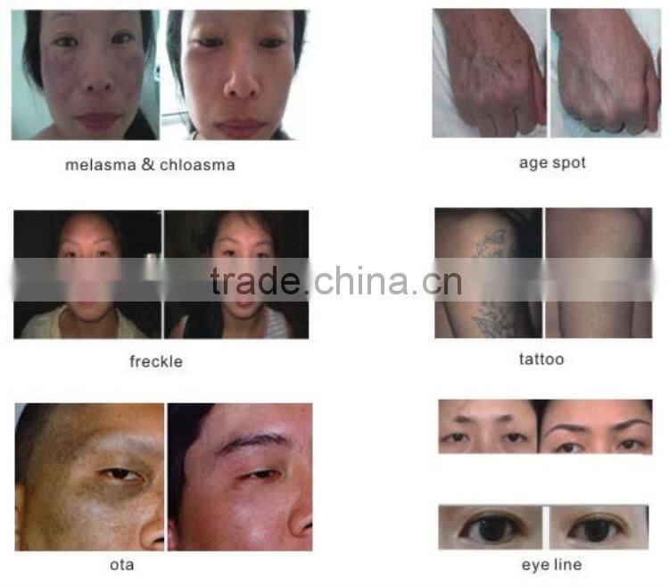 newest q switch nd yag laser tattoo removal system