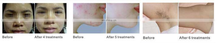 2015 newest Multifunction aesthetics ipl hair removal/e-light ipl rf/ipl beauty machine equipment with free ipl lamp