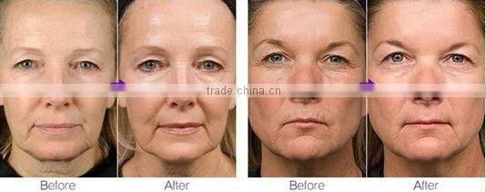 fractional rf face lift machine/microneedle skin rejuvenation microneedle fractional rf machine