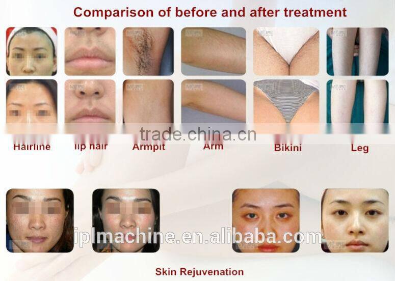 810 Diode laser hair removal 810 diode laser