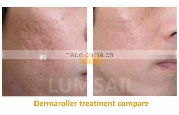 0.2 to 3.0mm micro needle derma roller 540 Titanium derma roller