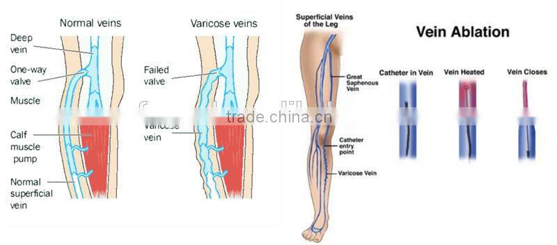 2015 New Product 30W Diode Laser 980nm Vascular Vein Stopper