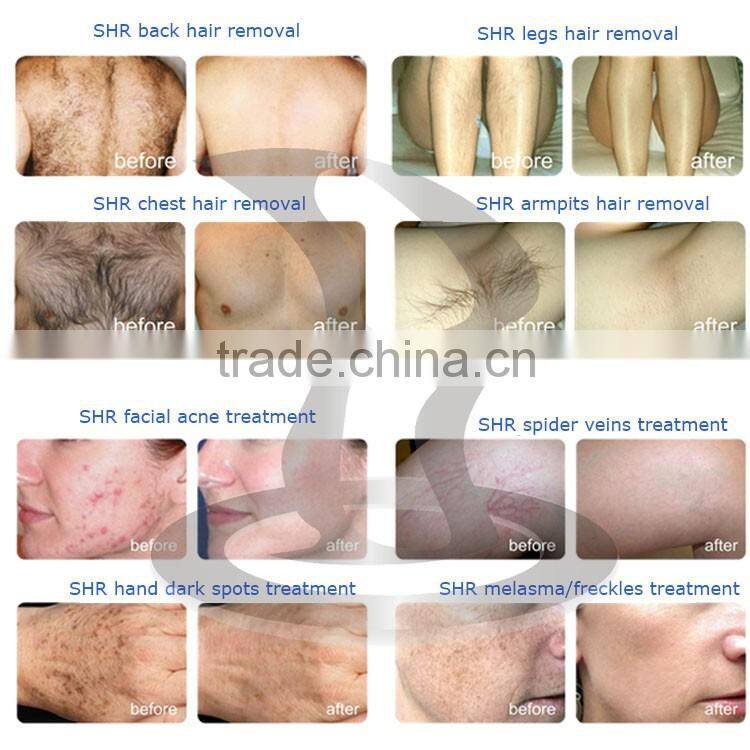 2016 NEW BD-OPT SHR fast hair removal / Nd yag laser tattoo removal machine for skin tightening