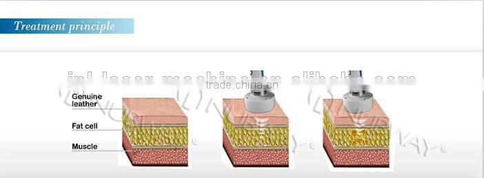 focused ultrasound,focused ultrasound ablation,ultrasound fat cavitation