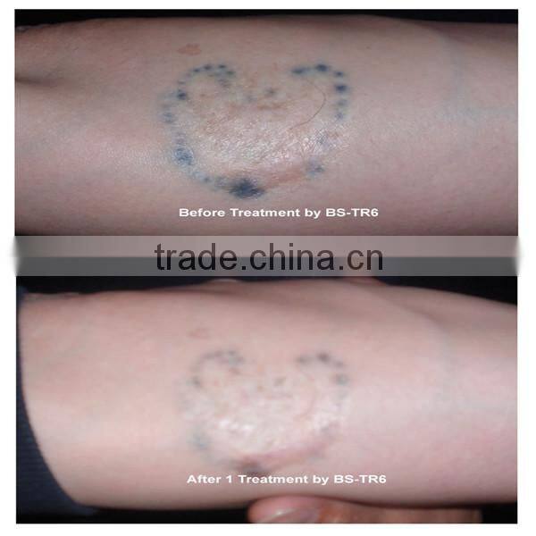 100% effects tattoo removal effects fda approved tattoo removal lasers