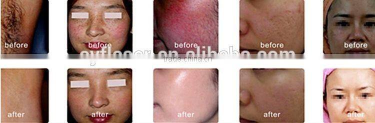 beauty machine stationary laser diod Fast and Efficien Fast and Efficient Laser Hair Removal Machine SHR 808 Diode Laser