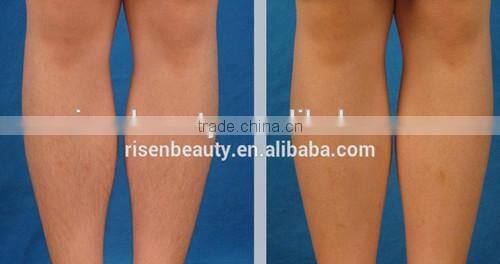 New Product Salon Use Laser Hair Removal Laser Hair Removal E-light IPL