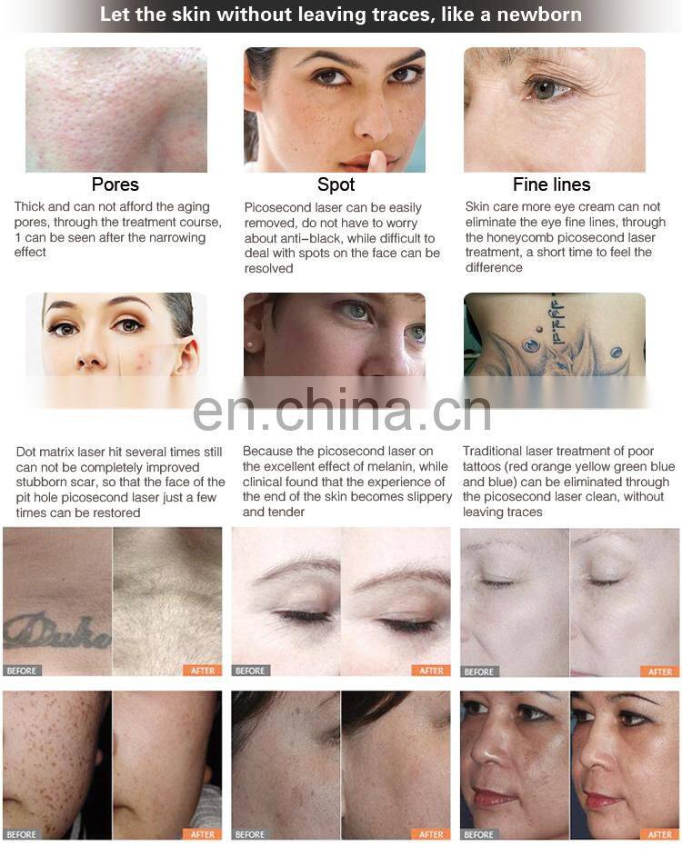 Medical CE Approved 2019 Newest Technology Tattoo Removal 755 nm Picosecond Laser