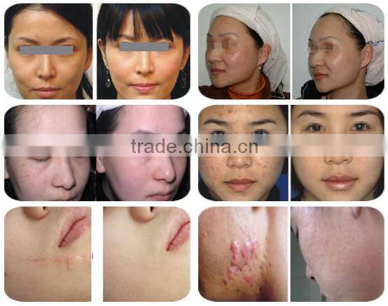 laser scar removal machine / laser acne removal machine / co2 laser for vaginal tightening