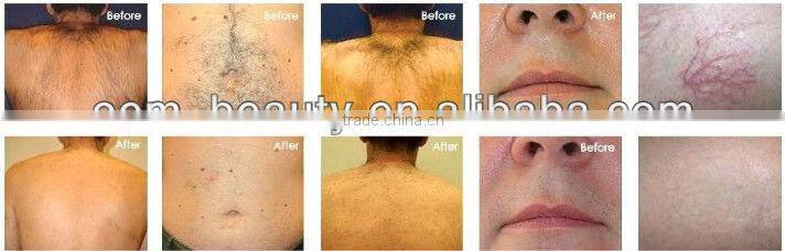 2013 permanently hair removal diode q-swithed laser machine for promotion