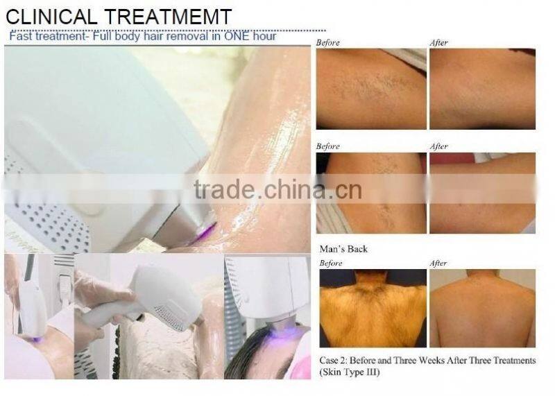 Hair remove 808nm diode laser hair removal beauty device