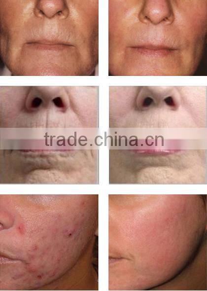 CE and RoHS korea Titanium 300&720 &1200 pins Bionic galvanic Skin nurse wrinkles eliminate derma roller