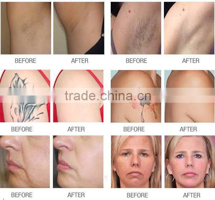 Lingmei Depilacion Laser Vertical Long Pulse Nd Yag Laser With Big Spot Size