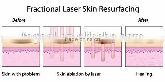 2015 new model new rf fractional laser co2