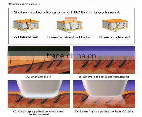 2015 Alibaba express diode laser hair removal portable suitable for all kinds of skin