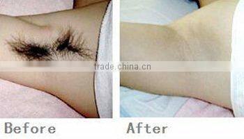 808 diode laser hair removal machine