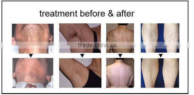 Promotion weifang huamei medical CE ipl hair removal machine for home use