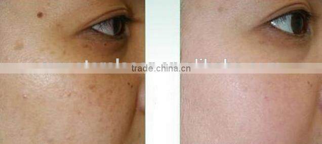 co2 fractional laser machine , co2 laser power supply/ Machines of fractional co2 laser