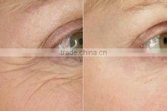 professional rf machine for face lift and skin rejuvenation
