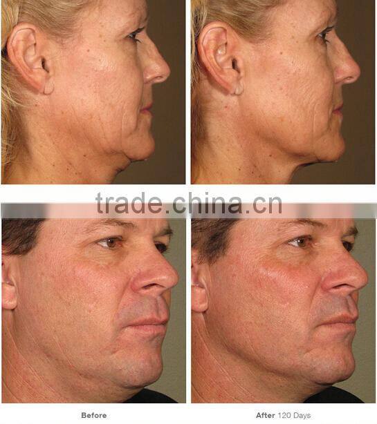 Hot sale neck treatments for sagging skin hifu system machine for anti aging anti wrinkle