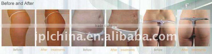 Cavitation Fat Burning Cellulite Reduction